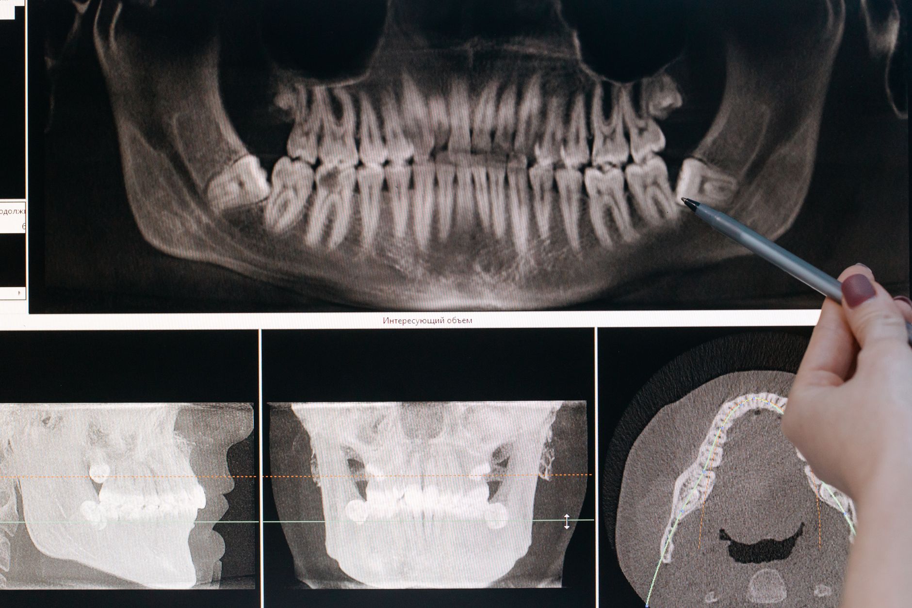 Dry Socket: Symptoms, Timeline, and How to Reduce Your Risk